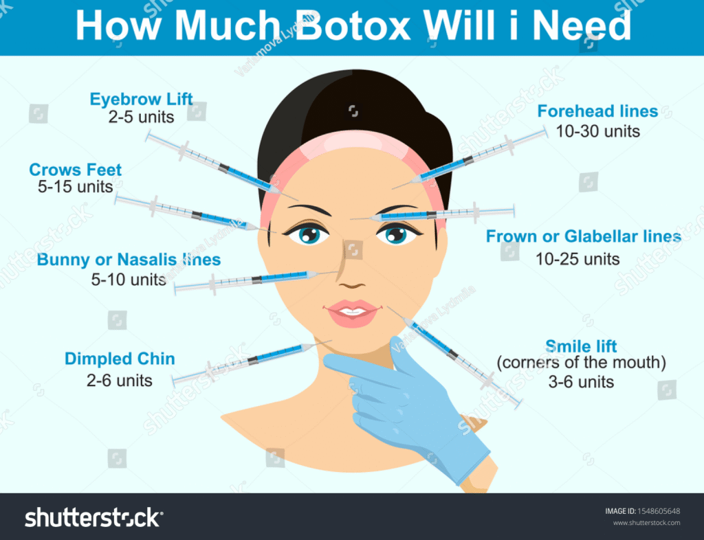 Botox injection areas