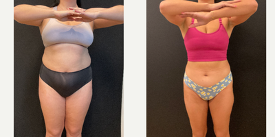 Ozempic before and after