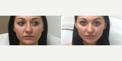 Teosyal before and after