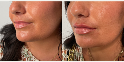 Juvederm before and after
