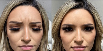 Dysport before and after