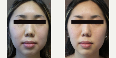 Xeomin before and after