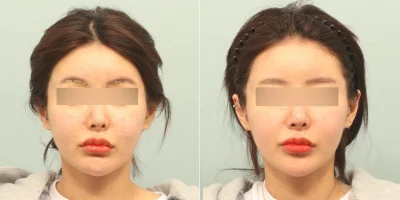 ultherapy before and after