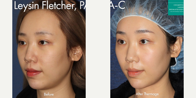 thermage before and after