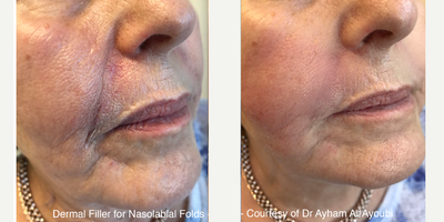 Ellanse before and after